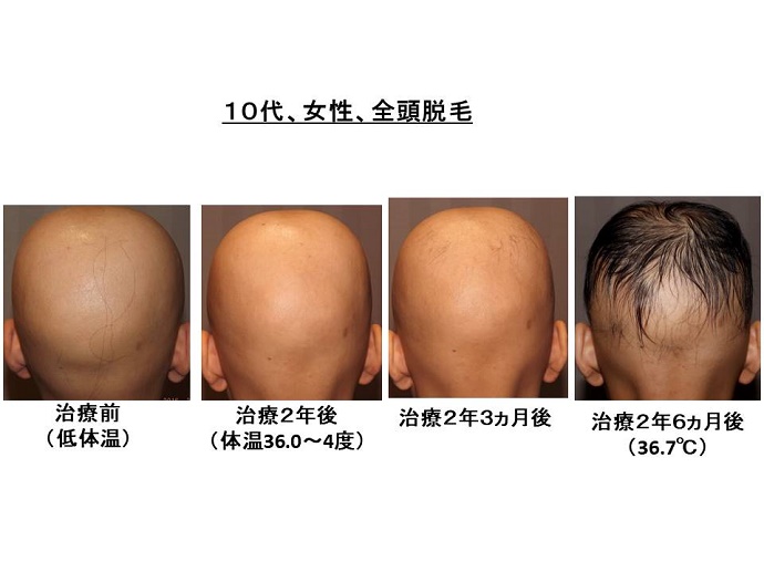 円形脱毛症　病院